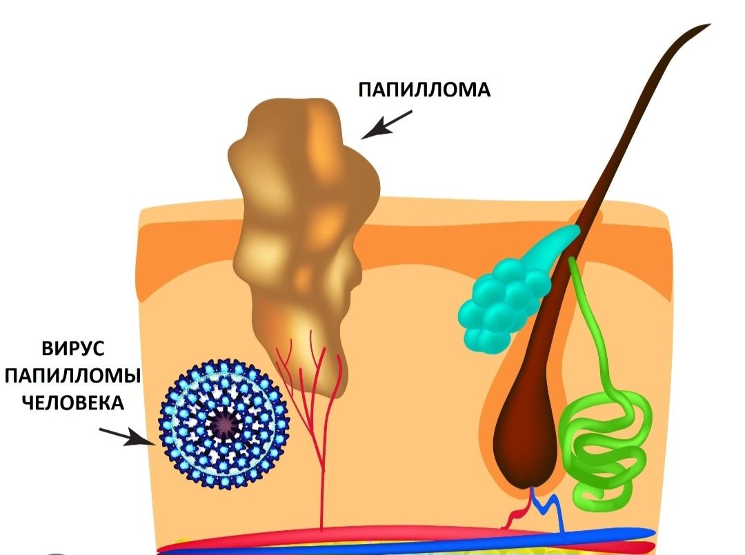 Удаление папиломы