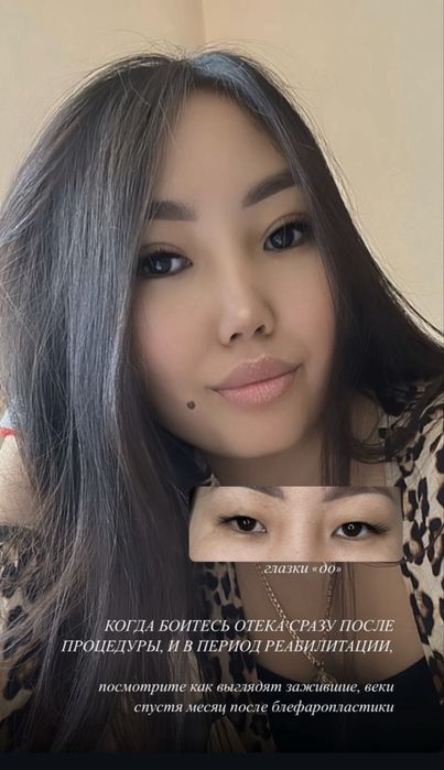 НИТЕВАЯ блефаропластика сангапруи