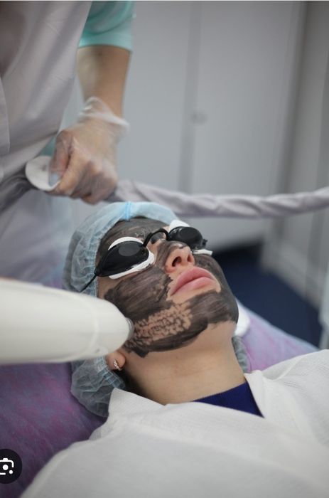 Карбоновый пилинг лица.