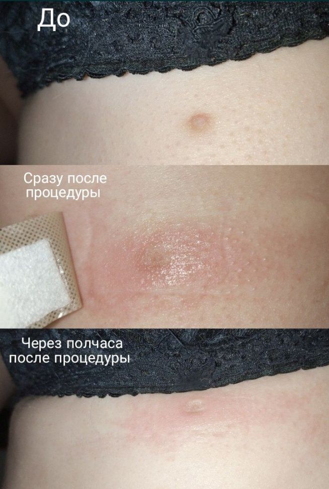 Удаление папиллом, родинок