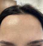 Botox programari