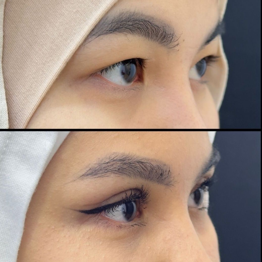 SKIDKADA Blefaraplastika, Nitevoy Sangapuri, browlifting