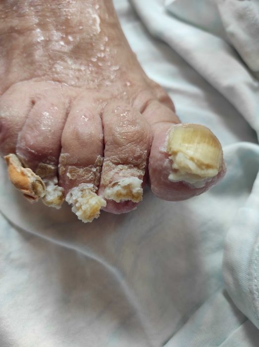 Медицински педикюр по домовете