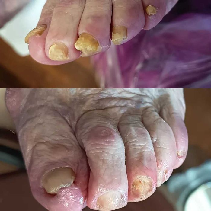 Pedichiură medicală Târgu Mureș