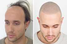 Micropigmentare scalp tricopigmentare efect indesire par alopecie