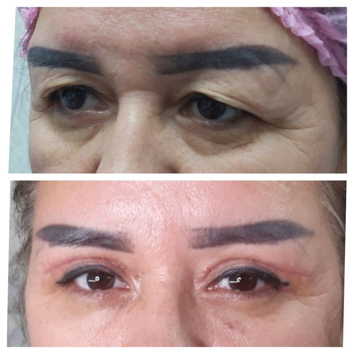 Лабиопластика,Броулифтинг,Блефаропластика.