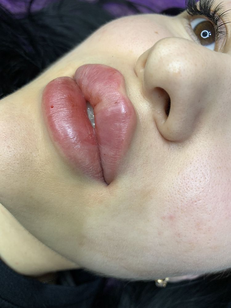 Увеличение губ, ботокс full face, мезотерапия