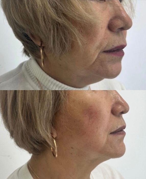 Микроигольчатый RF-лифтинг