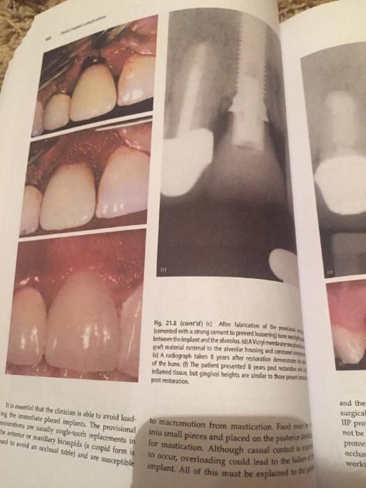 Dental Implant Complications J.Froum,2nd edition 2016