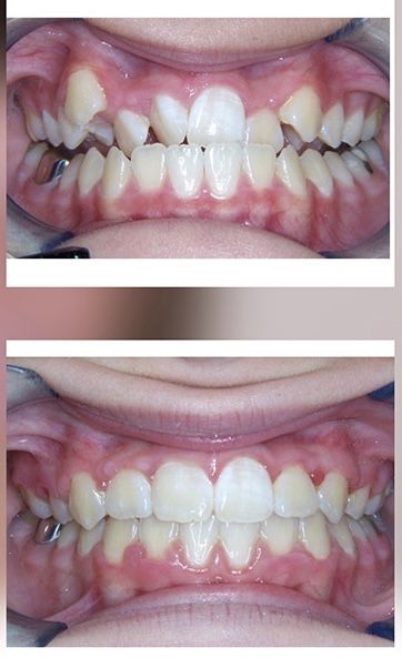 Aparate dentare ortodontice Iasi. Consultație gratuită!
