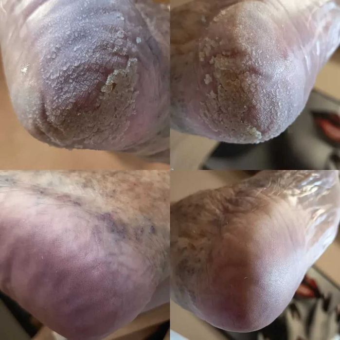 Pedichiură medicală Târgu Mureș