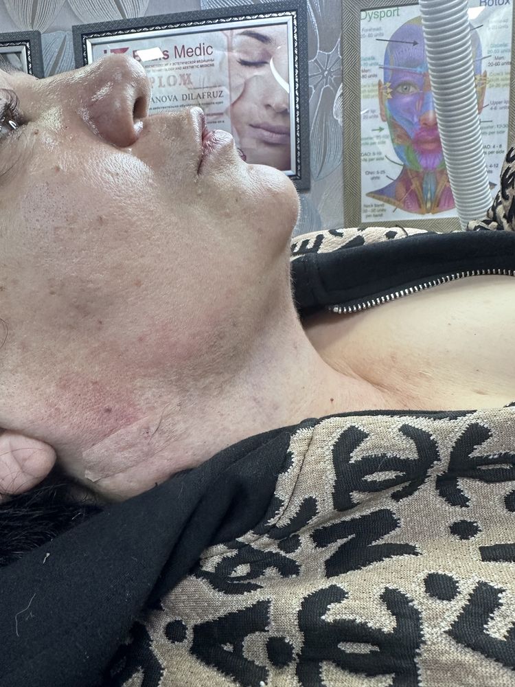 Skidkada Blefaraplastika, podborodka olish kesmasdan va boshqa muolaja