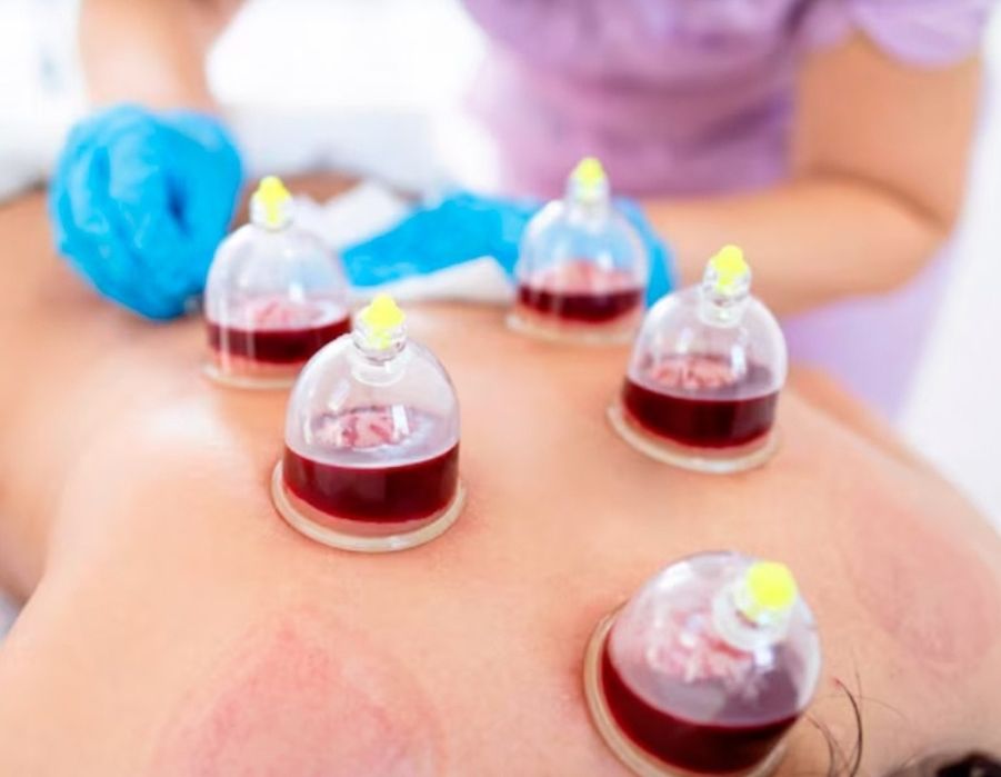 Хиджама женщинам .