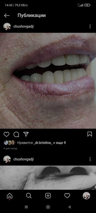 зубные протезы с гарантией