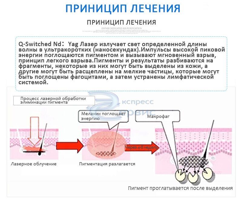 Лазер для удаления татуажа