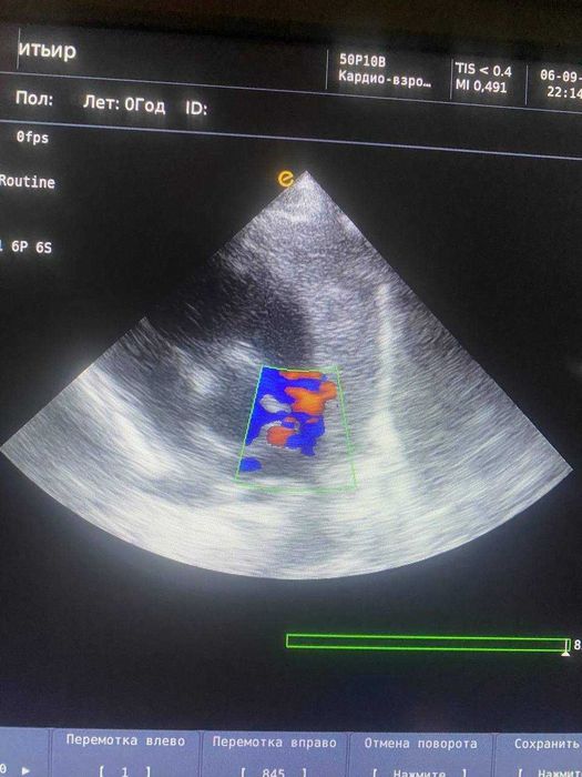 Портативный УЗИ аппарат EMP G30