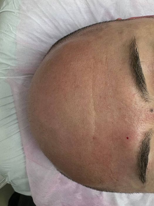 Чистка,  пилинг, мезотерапия, ботокс