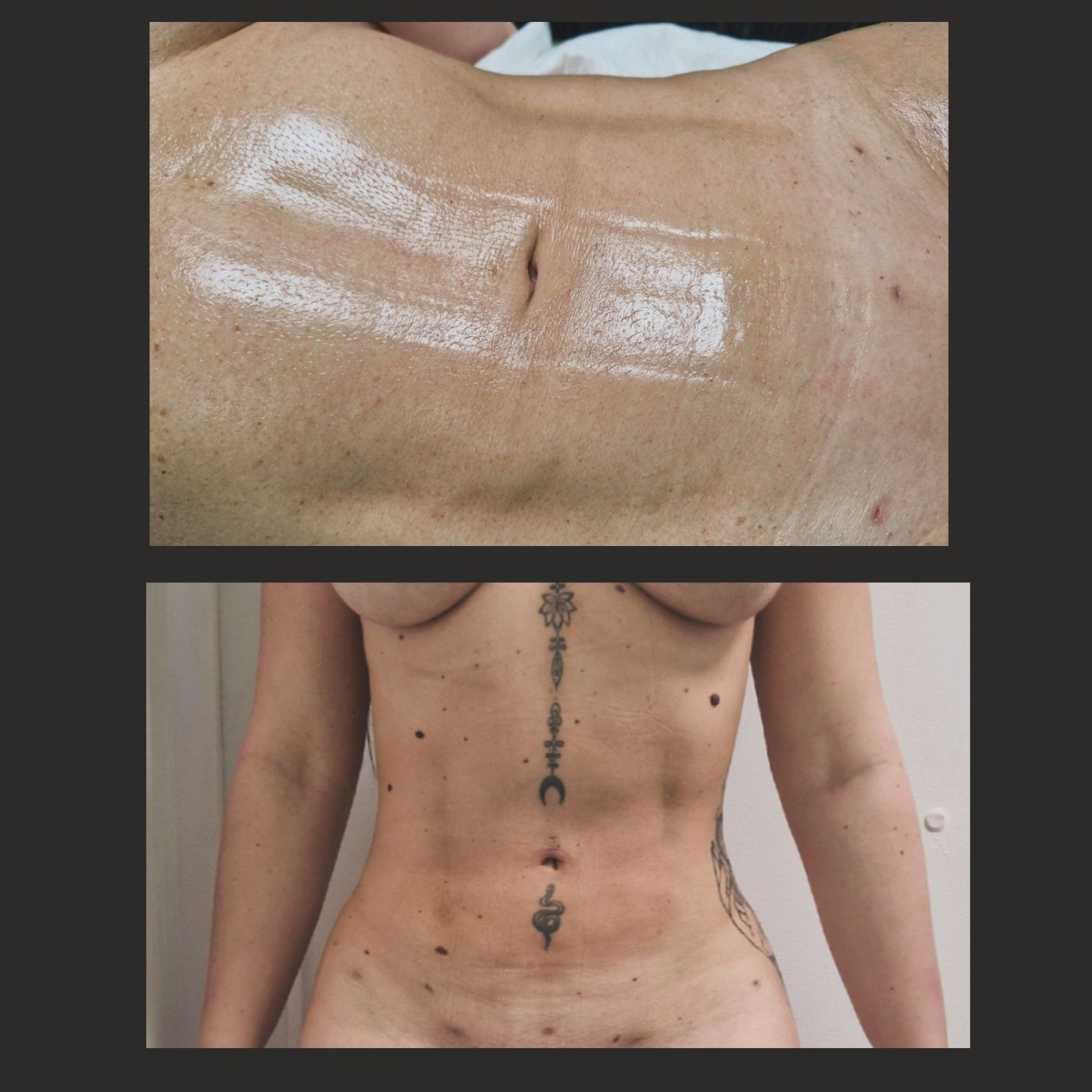 Drenaj limfatic manual post opertor bbl , liposuctie , abdominoplastie
