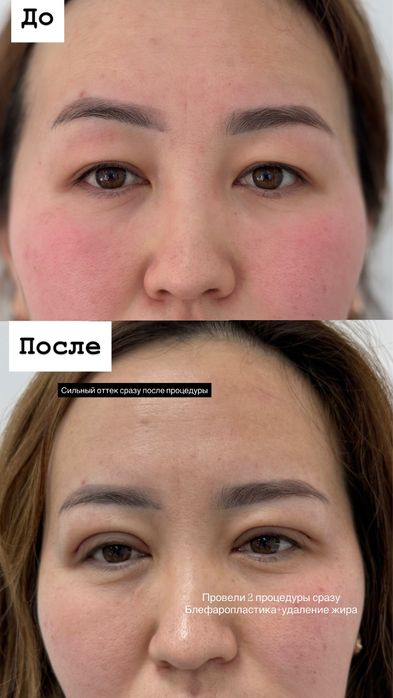 НИТЕВАЯ блефаропластика сангапруи