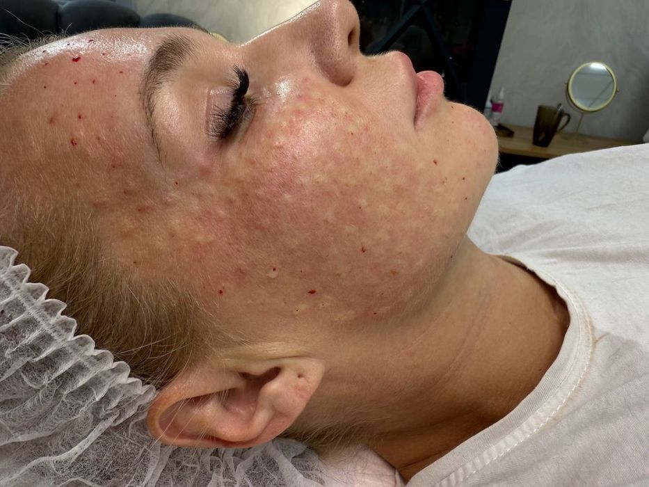 Чистка,  пилинг, мезотерапия, ботокс