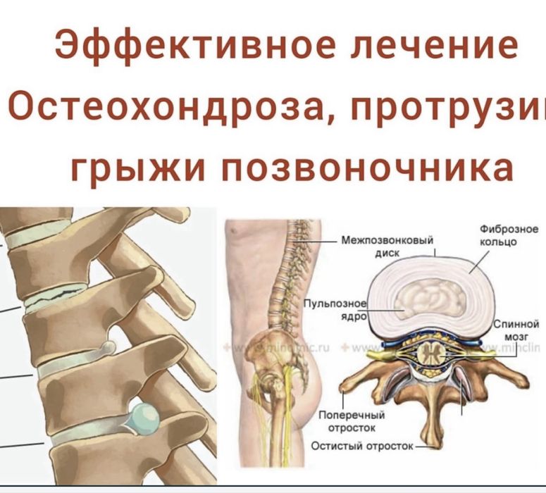 ЛЕЧЕБНЫЙ МАССАЖ и после инсульта