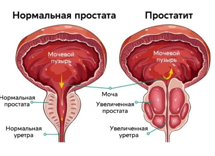 Массаж простаты.