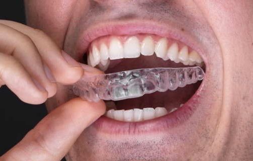 Индивидуальные ретенционные каппы стоматология