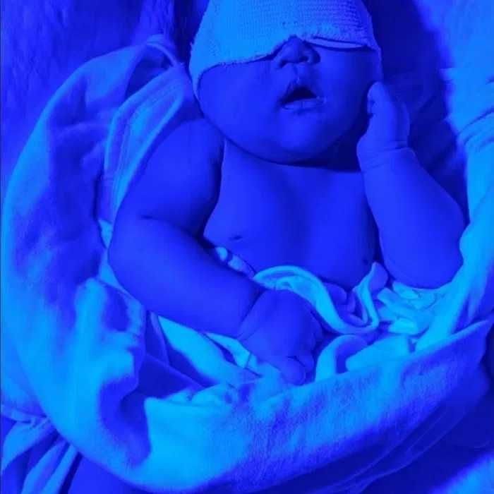 Fotolampa va BILIRUBIN miqdorini qonsiz aniqlash 50000