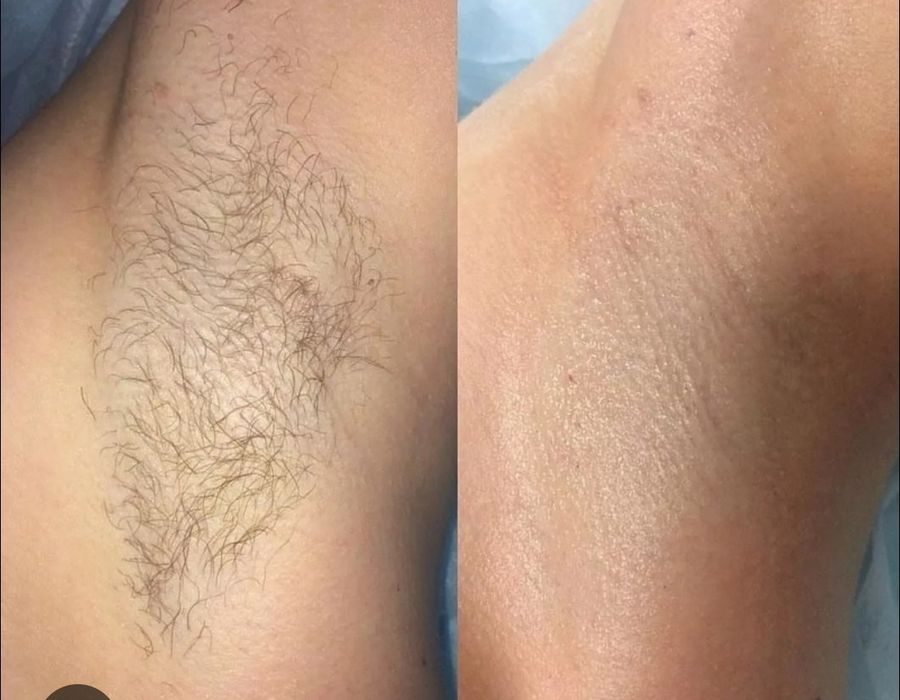 Киприк экиш депеляция кош куз ламинатцияси