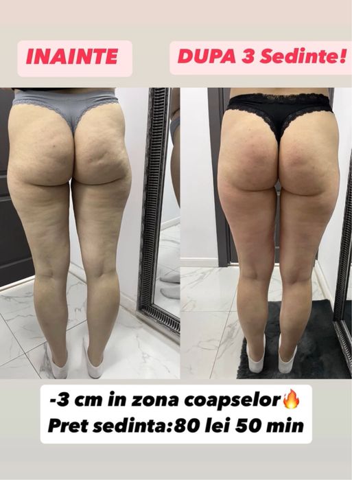 Masaj anticelulitic si remodelare corporala!