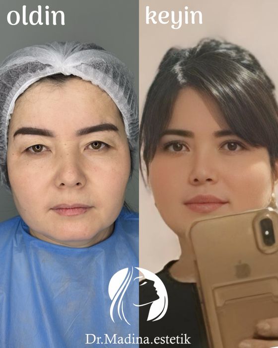50% chegirmada blefaroplastika