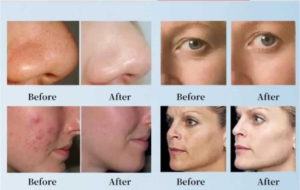 Aparat Hidrodermabraziune Peeling Acnee Riduri  RF Pen  NOU