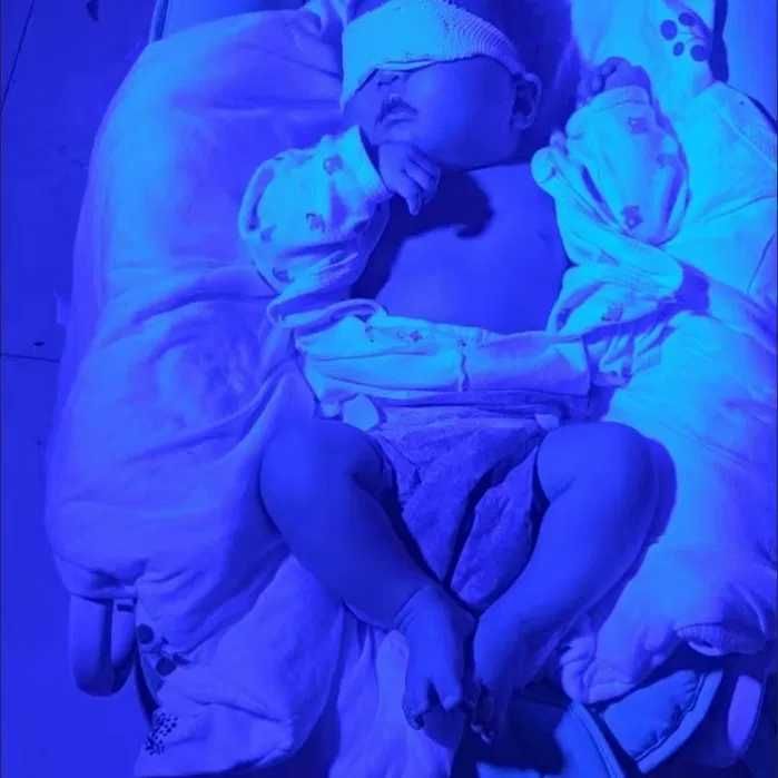 Фотолампа и замер билирубина без крови