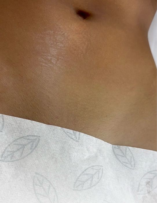 Epilare definitiva laser Bucuresti Sector 3 (zona trapezului)