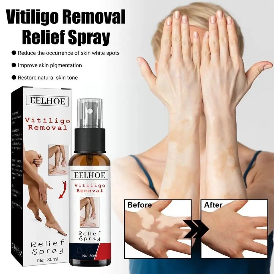 Spray Vitiligo, Spray pentru pete Vitiligo 30ml , Extras din plante