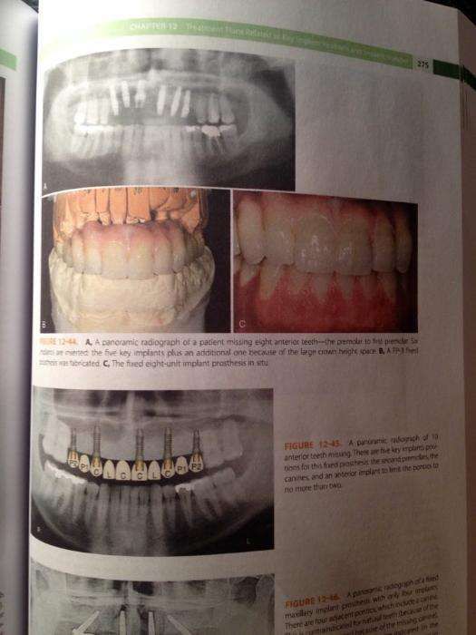 Dental Implant Prosthetics, 2ed (2015)