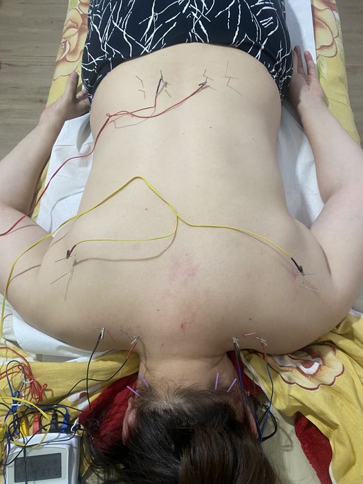 Recuperare Neurologică, Chiropractica,Acupunctură, Cupping( Ventuze)