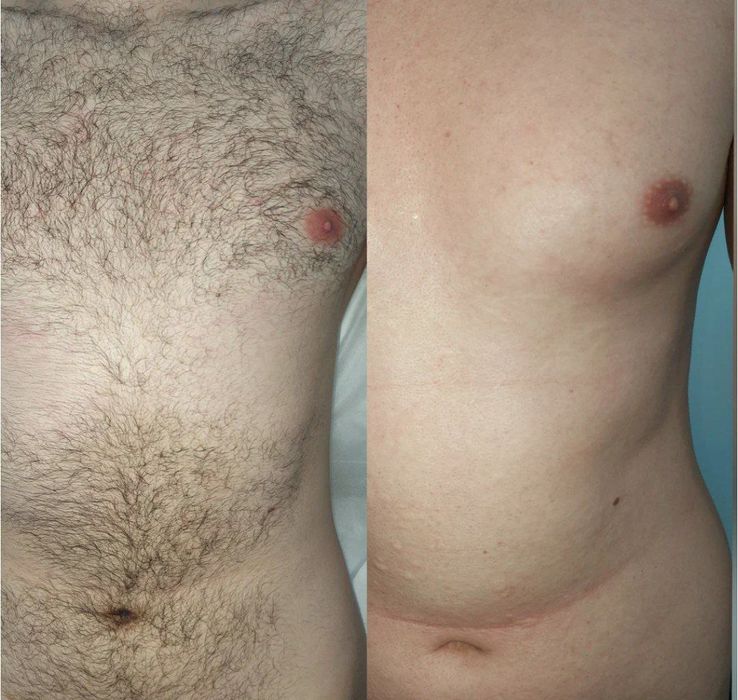 Депиляция мужская и женская