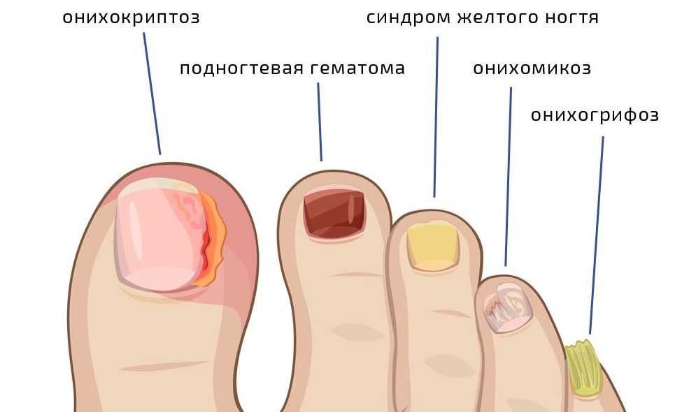 Проблемы с вросшим ногтем или мозоли? Мы вам поможем!