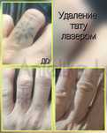 Удаление татуажа и тату неодимовым лазером .Ориентир остановка Электро