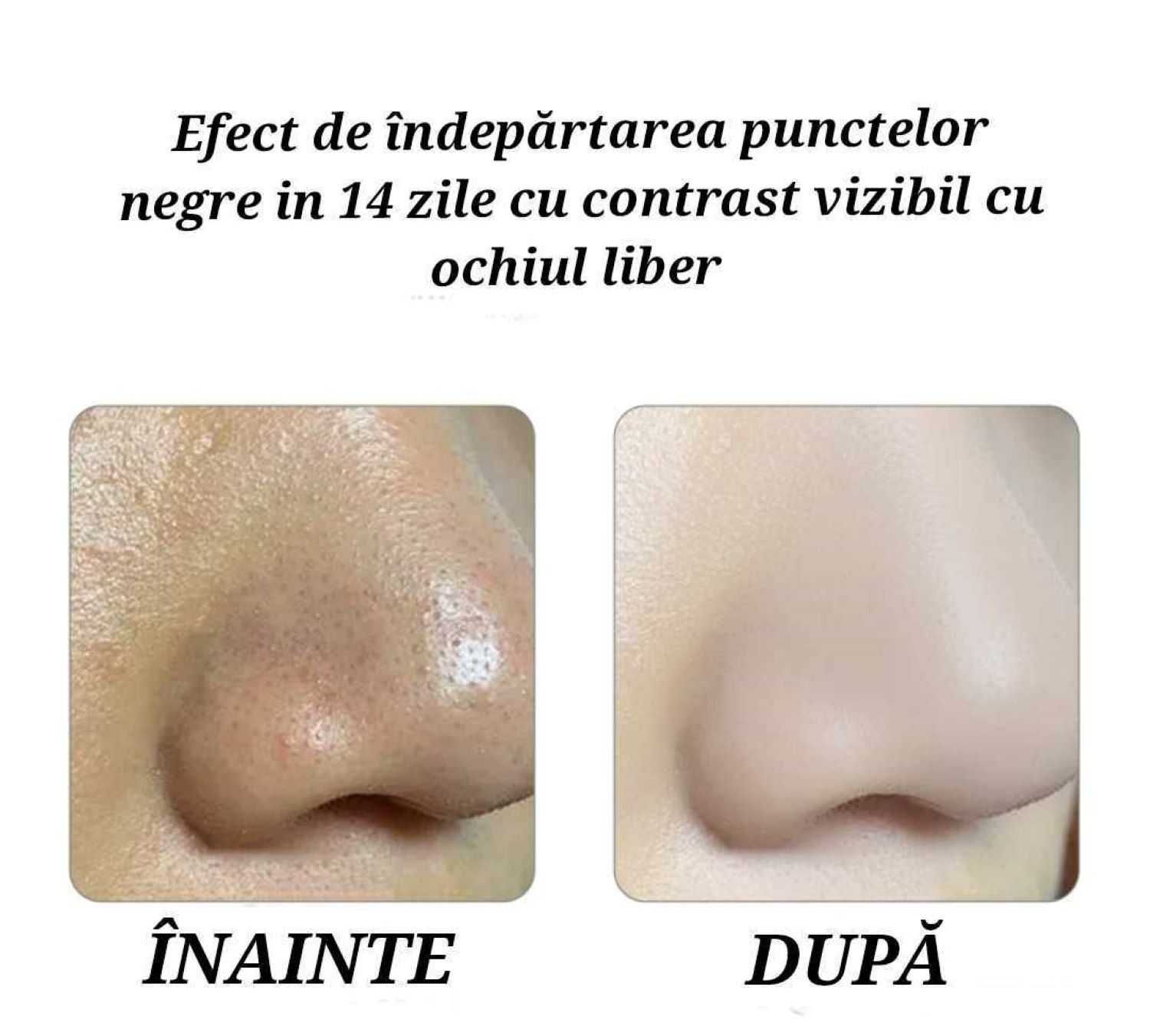 Aparat profesional ingrijire faciala, aspirat puncte negre wifi