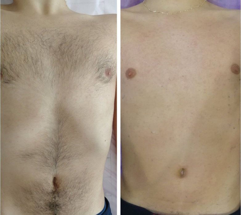 Депиляция мужская и женская