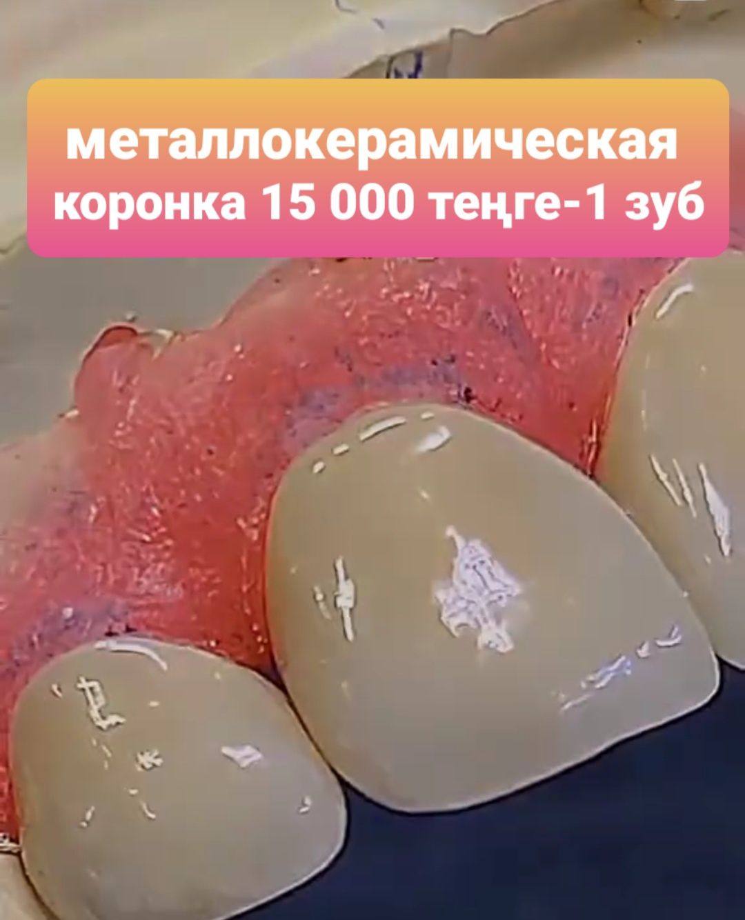 Металлокерамические коронки 15 000тг- 1 зуб