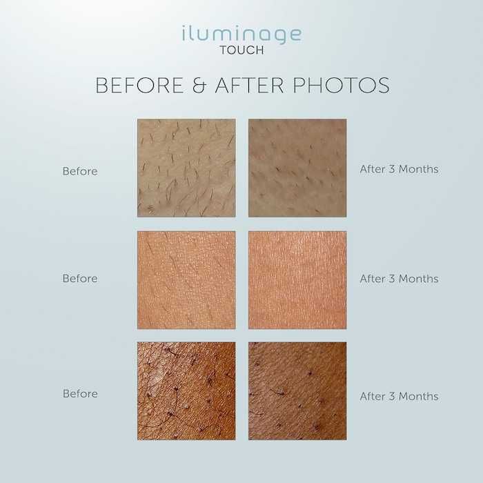 Iluminage TOUCH epilare permanenta IPL