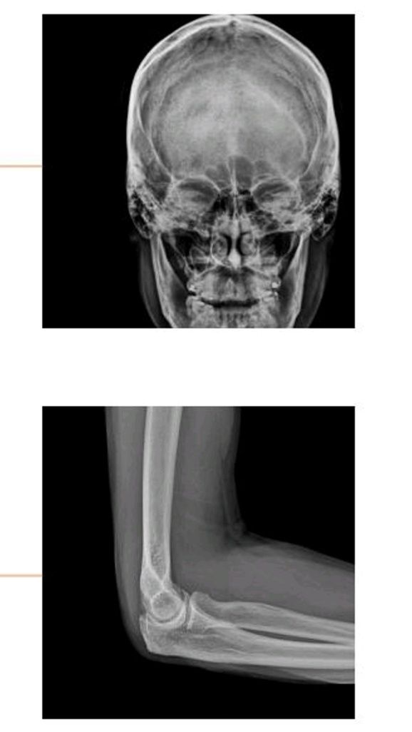 Портативный цифровой рентген аппарат. Mobile X-ray