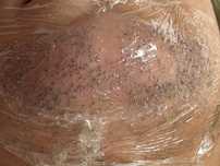 Electroepilare | Epilare permanentă | Definitivă | Electroliză