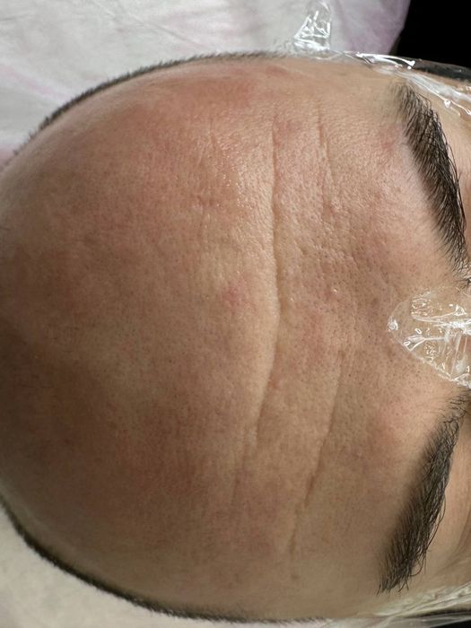 Чистка,  пилинг, мезотерапия, ботокс