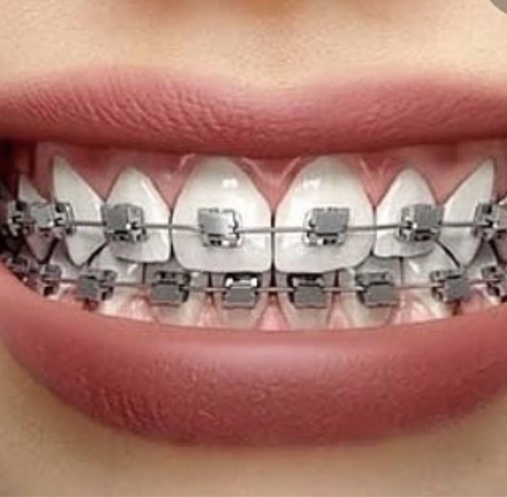 Бректеты 30000 kzt.  На обе 60000kzt.