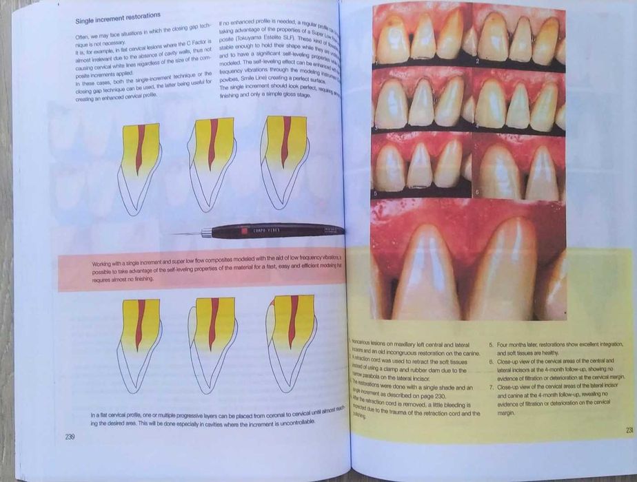 Layers 2 Direct Composites: The Styleitaliano Clinical Secrets - 2022