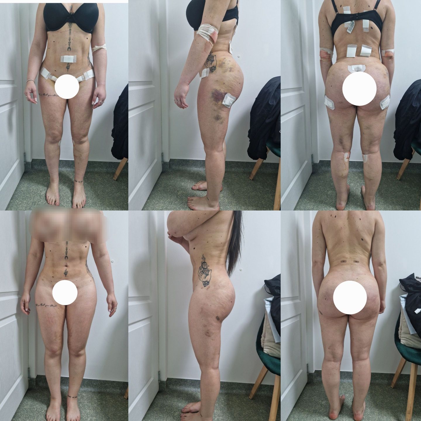 Drenaj limfatic manual post opertor bbl , liposuctie , abdominoplastie